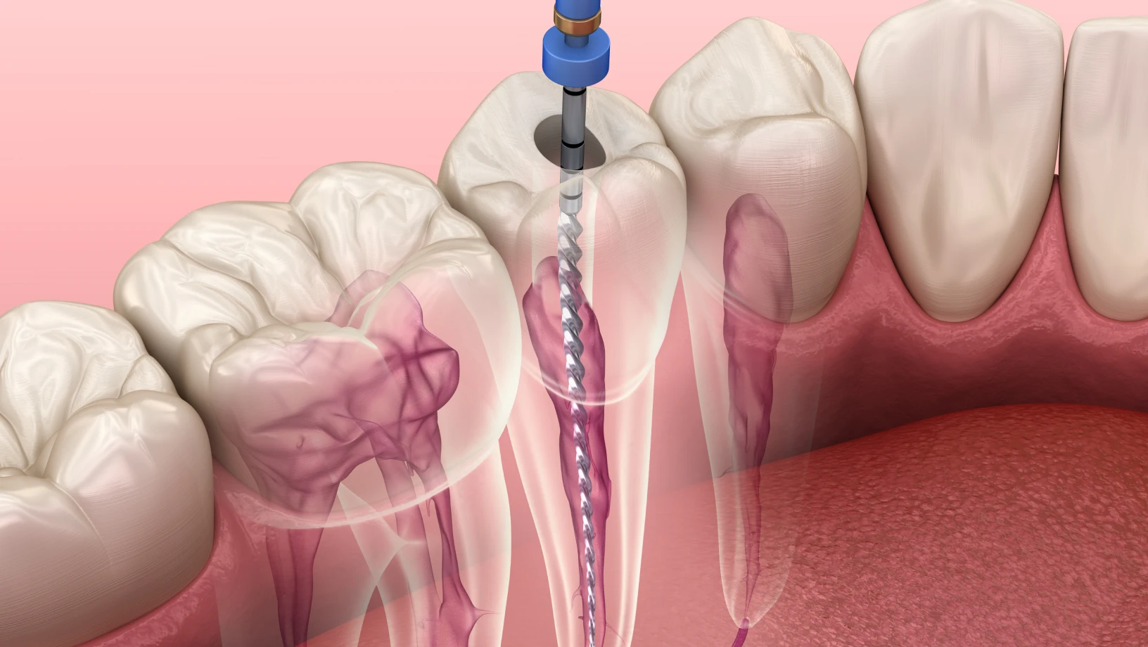 what happens when you visit a root canal specialist?