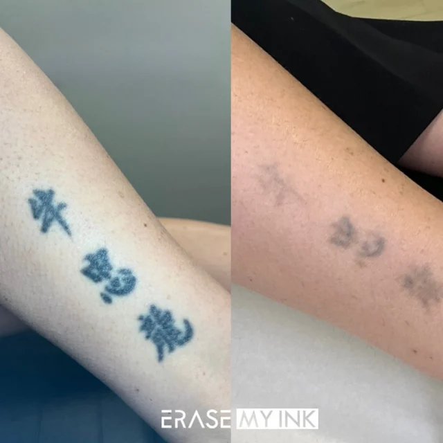 how effective is laser tattoo removal on old tattoos?